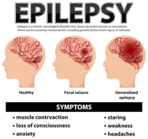 Best Epilepsy Treatment in Patna